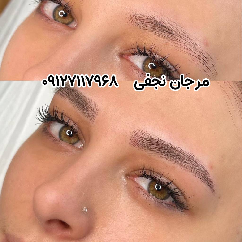 مراقبت های بعد از فیبروز ابرو