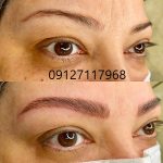 مراقبت های قبل از فیبروز ابرو