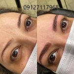 مراقبت های قبل از فیبروز ابرو