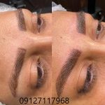 مراقبت های قبل از فیبروز ابرو