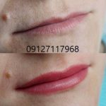 میکروپیگمنتیشن لب 1 IMG 20221026 WA0124 2