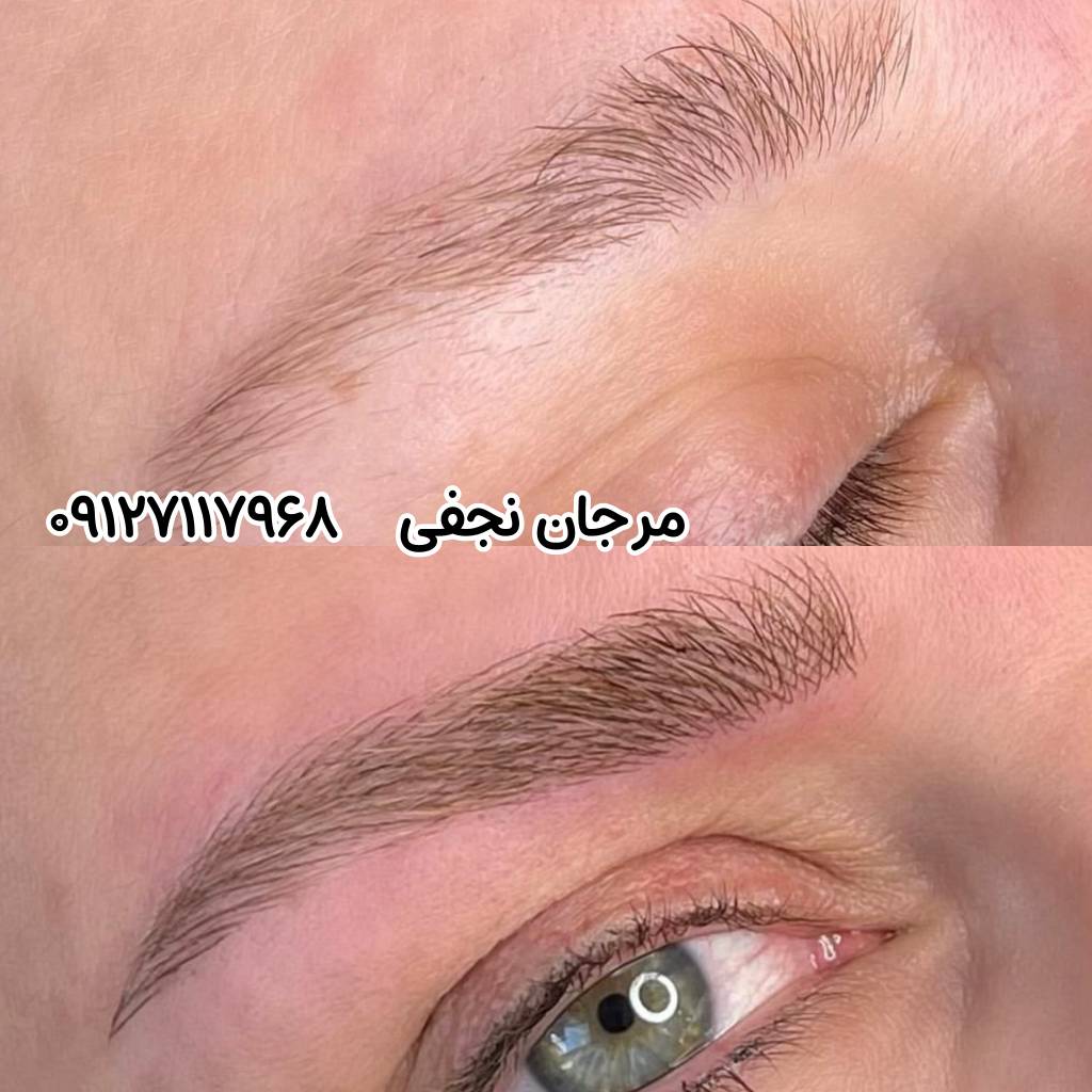 مراقبت بعد از فیبروز ابرو