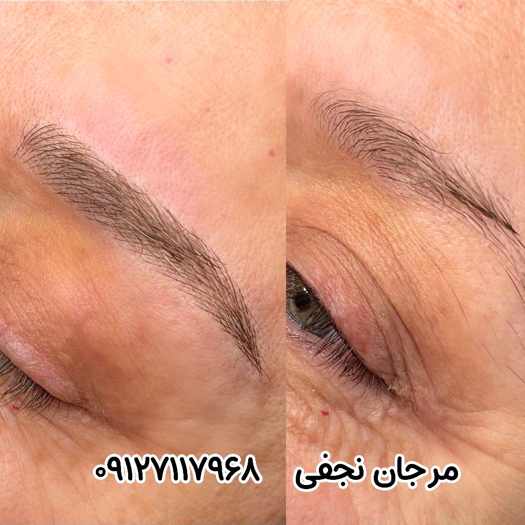 مراقبت های بعد از ترمیم فیبروز ابرو
