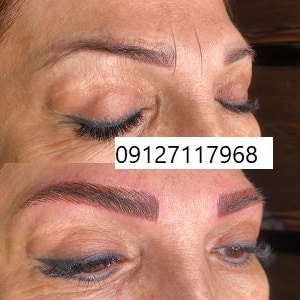 هزینه فیبروز ابرو چقدر است