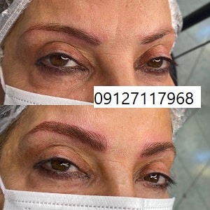 هزینه فیبروز ابرو چقدر است