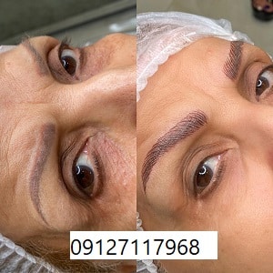 هزینه فیبروز ابرو چقدر است