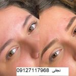 ترمیم هاشور ابرو 3 بهترین مرکز فیبروز ابرو با بهترین هزینه فیبروز ابرو در تهران کجاست؟