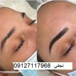 ترمیم هاشور ابرو 5 هزینه فیبروز ابرو در تهران در سال1402 در تهران چقدر است؟