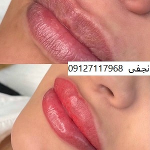 میکروبلیدینگ لب