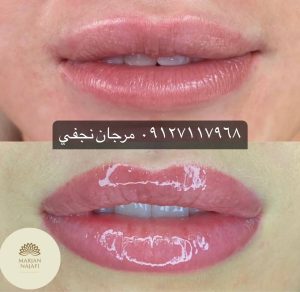قیمت خط لب 17 قیمت تاتو خط لب یا تاتو لب در تهران در سال1402 چقدر است؟