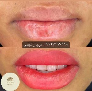 قیمت خط لب 15 قیمت تاتو خط لب یا تاتو لب در تهران در سال1402 چقدر است؟