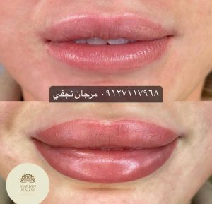 قیمت خط لب 16 قیمت تاتو خط لب یا تاتو لب در تهران در سال1402 چقدر است؟