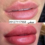 میکروپیگمنتیشن رژ لب 1 میکروپیگمنتیشن لب در سال 1402