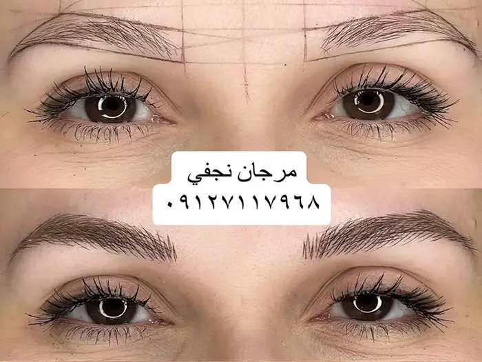 آیا میتوانم فیبروز ابرو را خودم انجام دهم؟ 35 فیبروز ابرو
