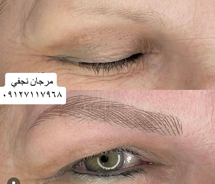 قبل و بعد فیبروز