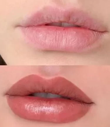 شیدینگ لب کالباسی قبل و بعد
